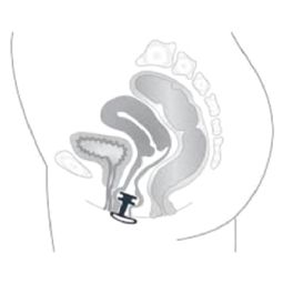 efemia Vaginalprop