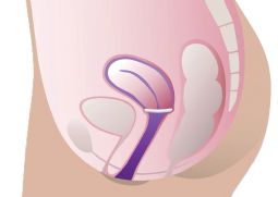 ProFem Oval Prolapsring