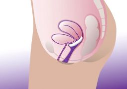 ProFem Shell Vaginalpessar - uden eller med støttemembran - klik for at se billedet i fuld størrelse - åbner i nyt vindue ProFem Shell Vaginalpessar - uden eller med støttemembran