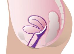 ProFem Urethra Prolapsring uden og med støttemembran